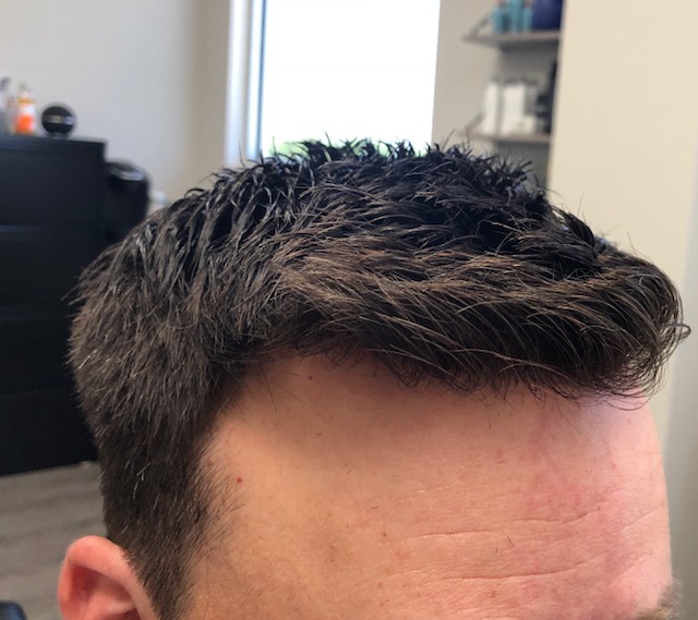 Non surgical hair replacement in Dallas